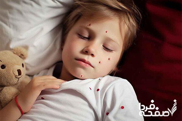 آبله مرغان چیست و تا چند روز واگیر دارد؟ / بایدها و نبایدهای بیماری آبله مرغان