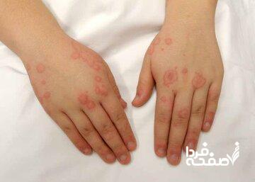 بیماریای که اغلب دامنگیر زنان است/ نگاهی به بیماری لاعلاج «سلنا گومز»