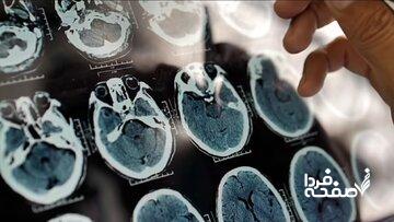 هشدار؛ کمبود این ویتامینها در بدن منجر به زوال عقل میشود