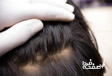 مرفهین اروپا و بچههای شمال شهر بیشتر درگیر شپش سر میشوند!/ دلیل جالب یک متخصص