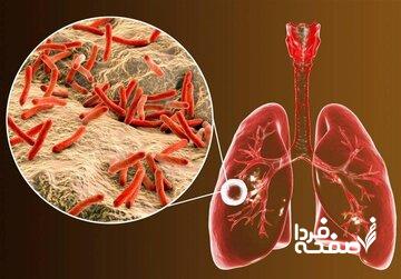 ابتلای ۶ هزار ایرانی به یک بیماری خطرناک ریوی/ ۸ استان در صدر شیوع بیماری